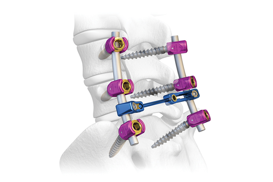 Ki sa-se-kolòn vètebral-implant