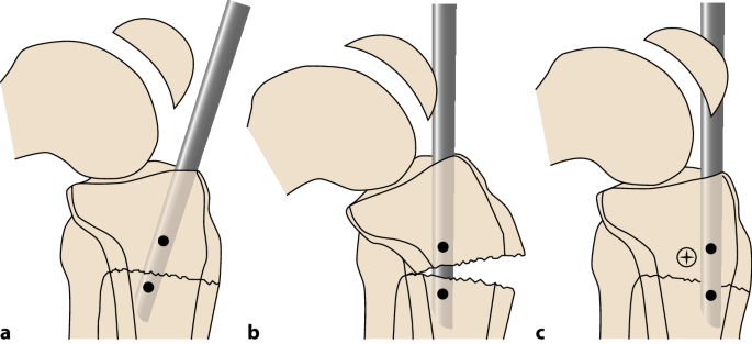 Tibial fracture, suprapatellar intramedullary nailing technique