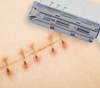 Surgical Skin Staplers, Medical Device Manufacturer