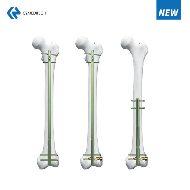 Dfn distal femur intrawelulay Neel 