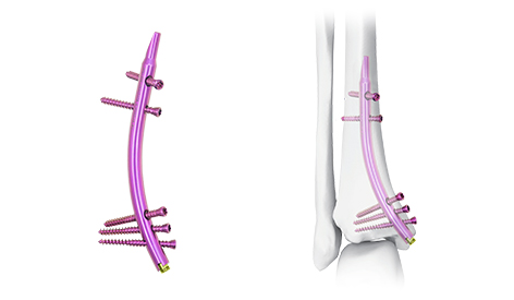 Distal tibiial dyrnak: Distal tiumal döwükleri bejermekde üstünlik